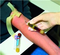 В Коми увеличилось количество ВИЧ-инфицированных
